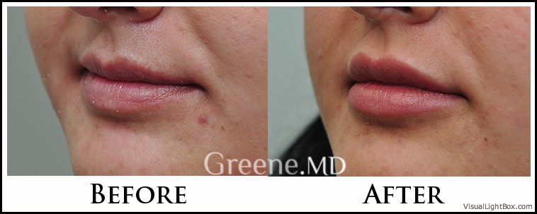 Lip Filler Case 57 Combined Image