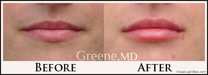 Lip Filler Case 73 Combined Image