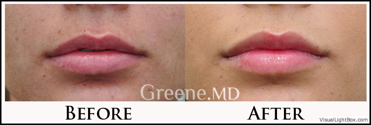 Lip Filler Case 32 Combined Image