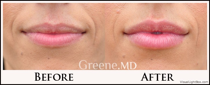 Lip Filler Case 24 Combined Image
