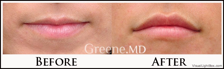 Lip Filler Case 33 Combined Image