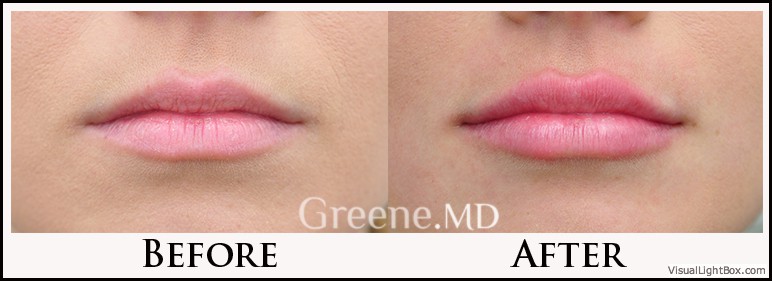Lip Filler Case 21 Combined Image