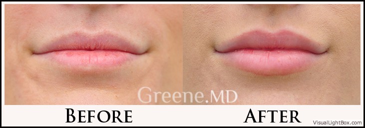 Lip Filler Case 22 Combined Image