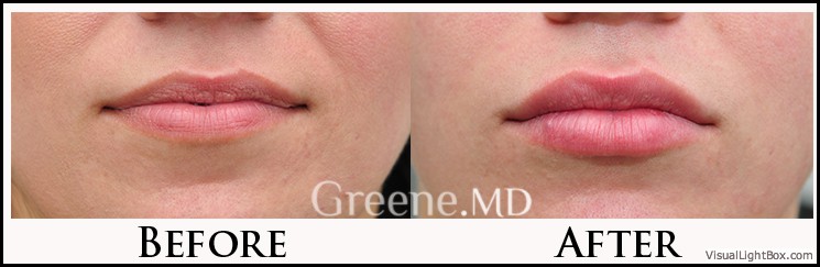 Lip Filler Case 64 Combined Image