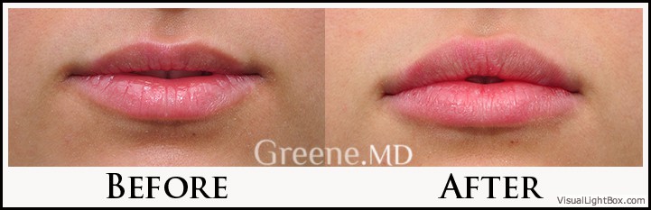 Lip Filler Case 34 Combined Image