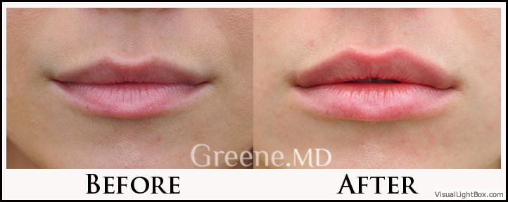 Lip Filler Case 76 Combined Image