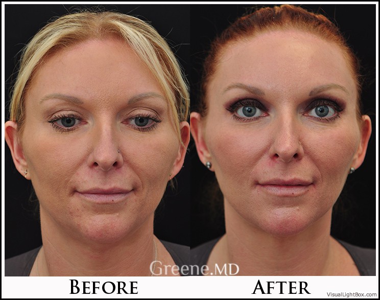 Ultherapy Case 5 Combined Image