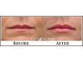 Lip Filler Case 91 Combined Image