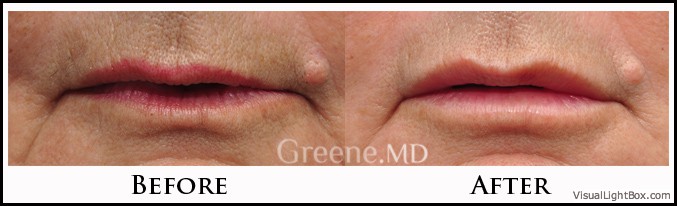 Coolsculpting Case 46 Combined Image