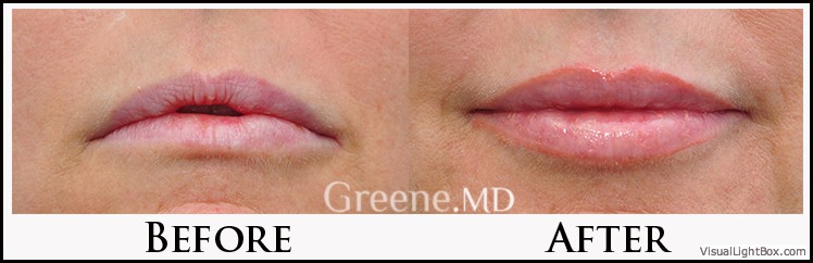 Lip Filler Case 36 Combined Image