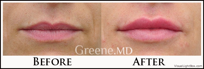Lip Filler Case 92 Combined Image