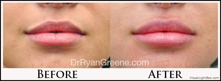 Lip Filler Case 13 Combined Image