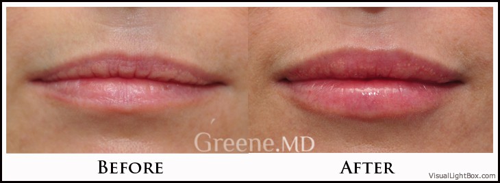 Lip Filler Case 47 Combined Image