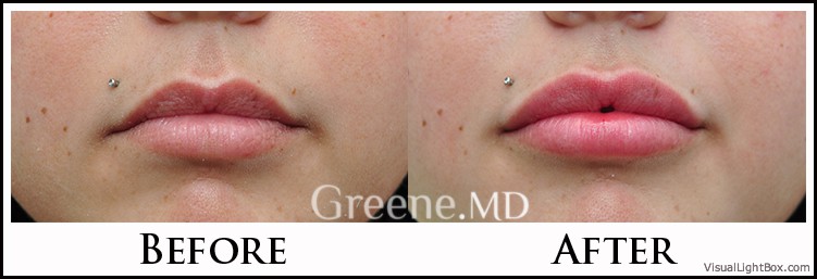 Lip Filler Case 37 Combined Image