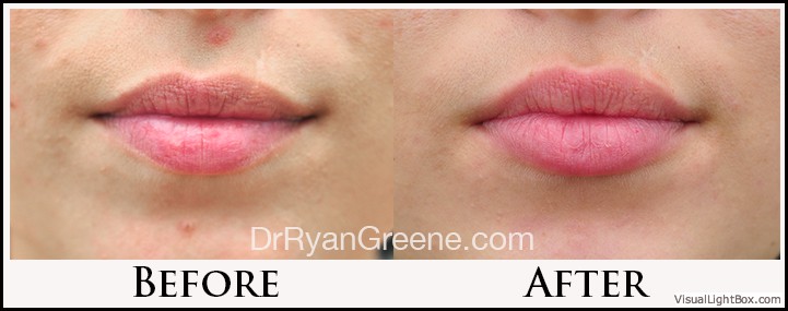 Lip Filler Case 14 Combined Image