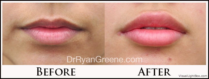 Lip Filler Case 23 Combined Image