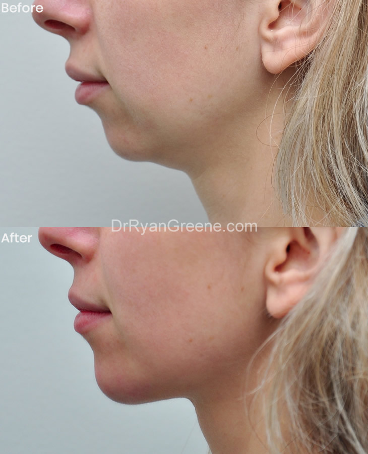 Lip Filler Case 118 Combined Image