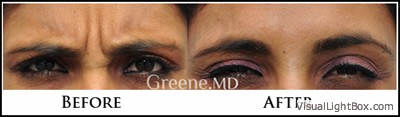 Botox and Dysport Case 9 Combined Image