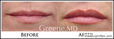 Lip Filler Case 53 Combined Image