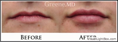 Lip Filler Case 54 Combined Image