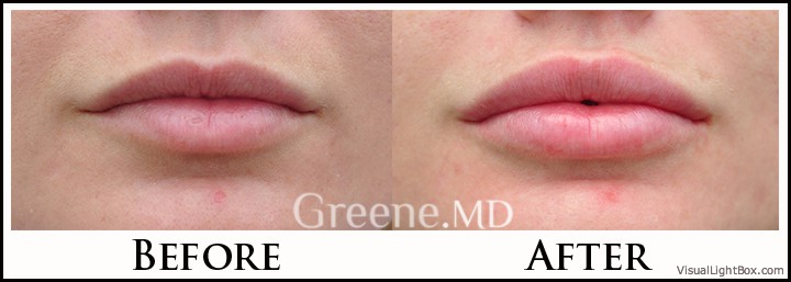 Lip Filler Case 93 Combined Image