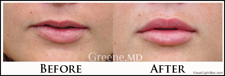 Lip Filler Case 41 Combined Image