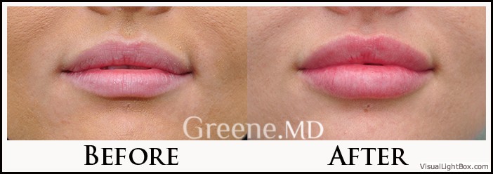 Lip Filler Case 67 Combined Image