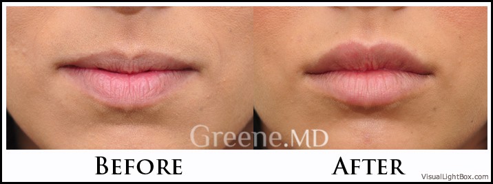 Lip Filler Case 48 Combined Image