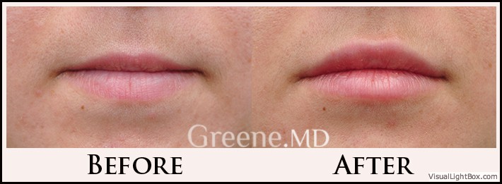 Lip Filler Case 80 Combined Image