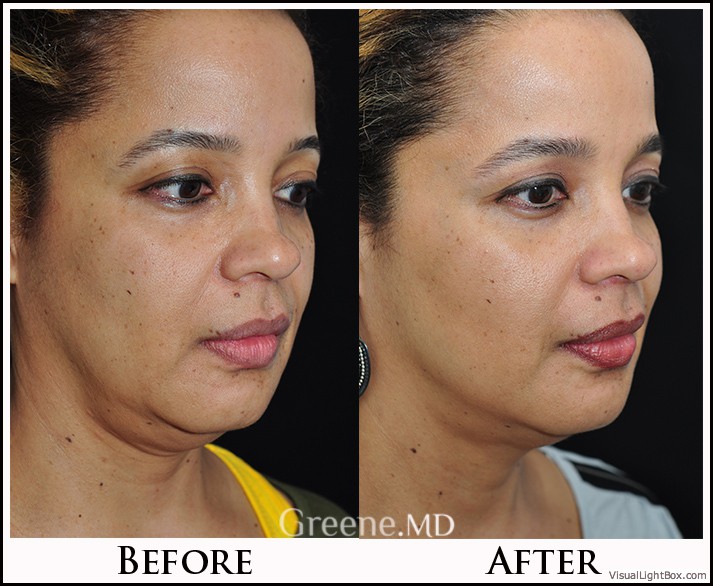 Ultherapy Case 3 Combined Image