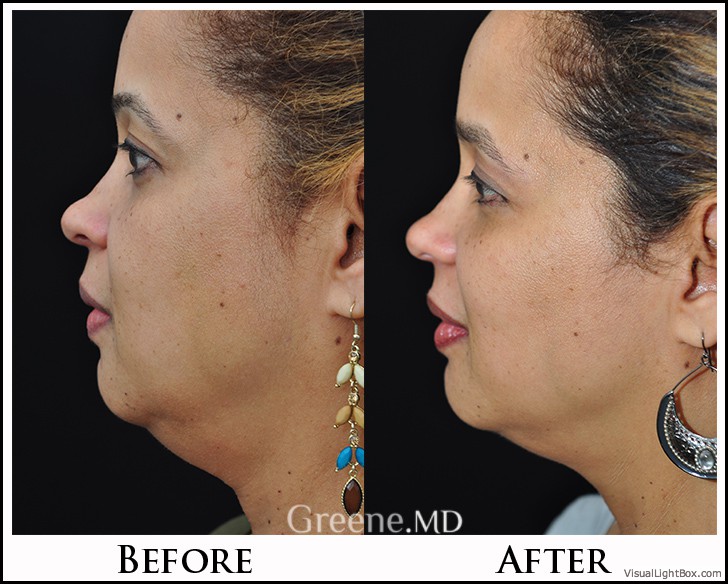 Ultherapy Case 3 Combined Image