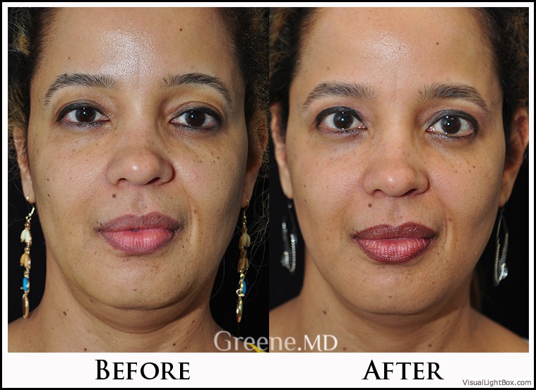 Ultherapy Case 3 Combined Image