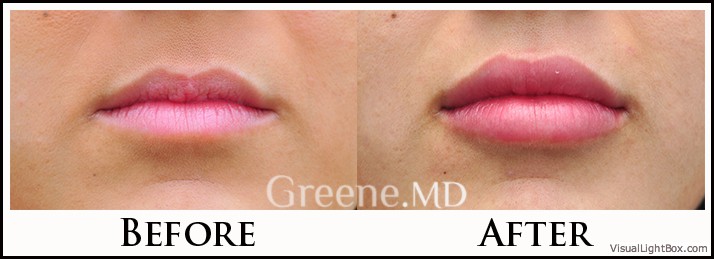 Lip Filler Case 88 Combined Image