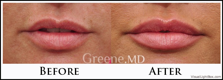 Lip Filler Case 55 Combined Image