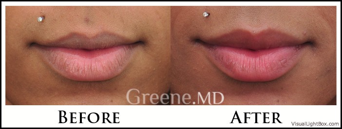 Lip Filler Case 56 Combined Image