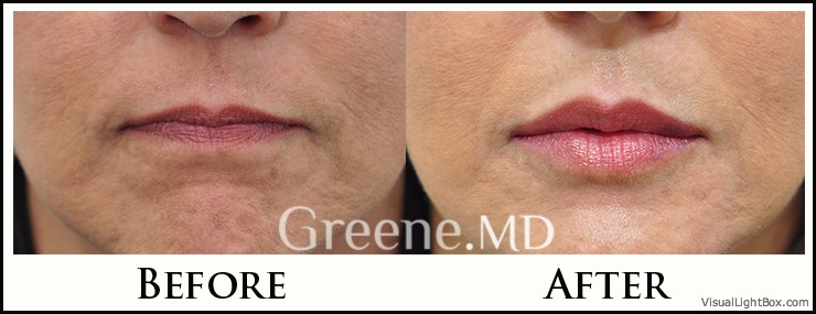 Lip Filler Case 62 Combined Image