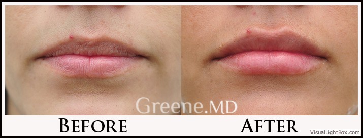 Lip Filler Case 26 Combined Image