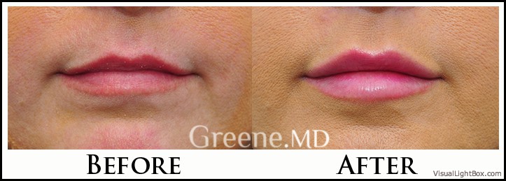 Lip Filler Case 58 Combined Image