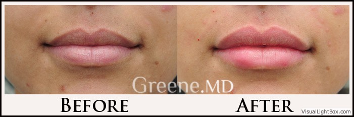 Lip Filler Case 68 Combined Image