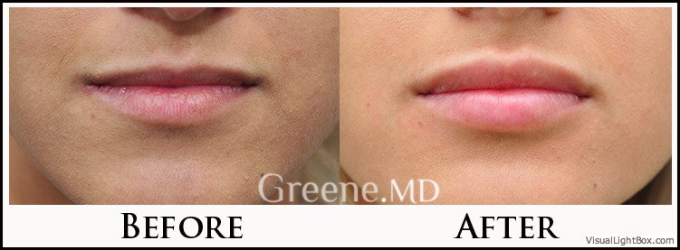 Lip Filler Case 89 Combined Image