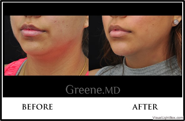 Kybella Case 3 Combined Image