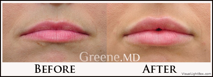 Lip Filler Case 27 Combined Image