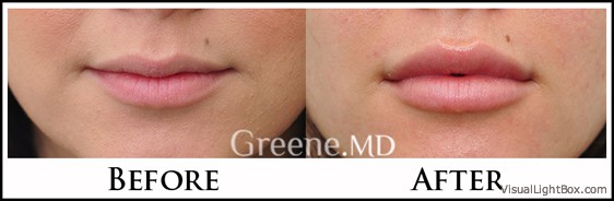 Lip Filler Case 1 Combined Image