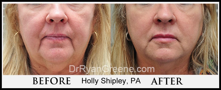 Lower Face Filler Case 6 Combined Image