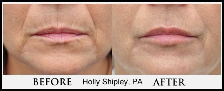 Lower Face Filler Case 5 Combined Image