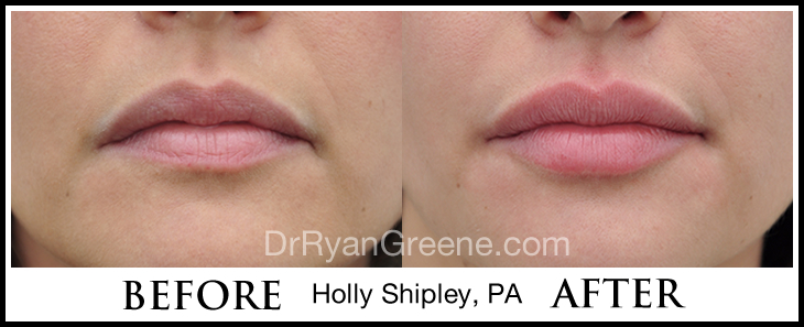 Lower Face Filler Case 3 Combined Image