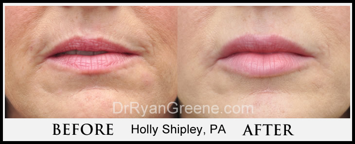Lower Face Filler Case 2 Combined Image