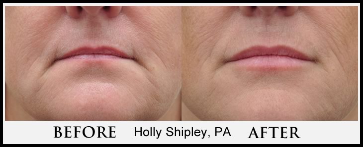 Lower Face Filler Case 1 Combined Image
