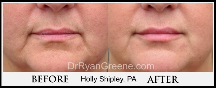 Lower Face Filler Case 7 Combined Image