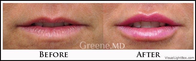 Lip Filler Case 39 Combined Image